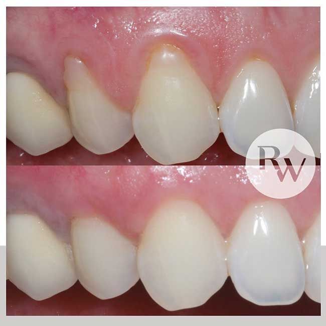 Gum contouring and gum grafts: before and after transformation