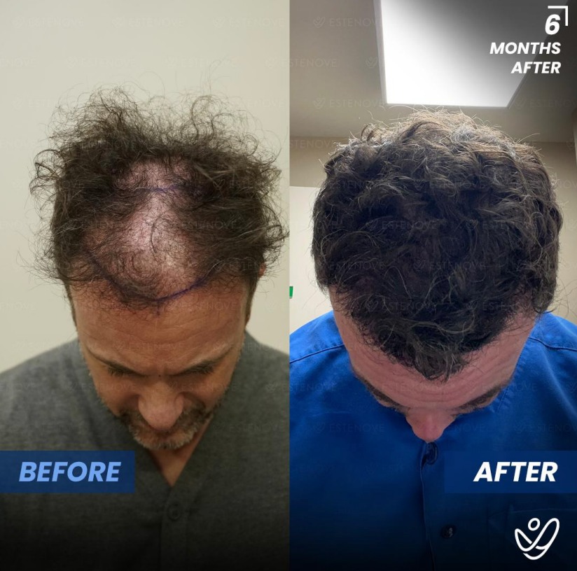 Before and after a hair transplant