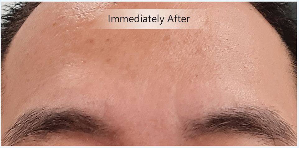 Real results from the Invity serum
