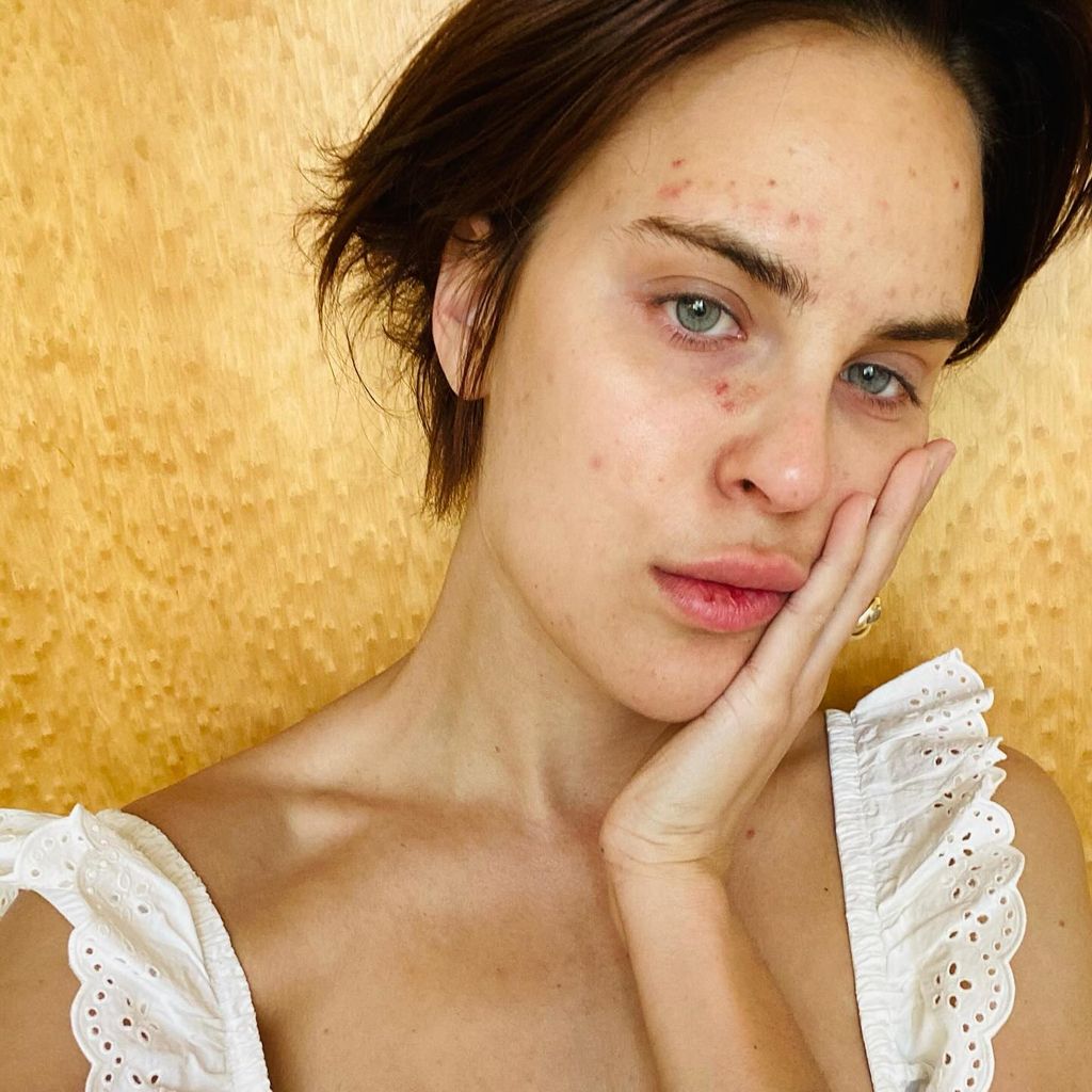 tallulah willis photo of skin picking disorder