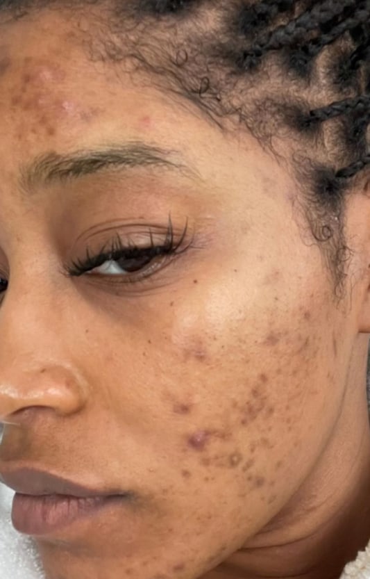 Keke Palmer shares her adult acne hyperpigmentation on TikTok