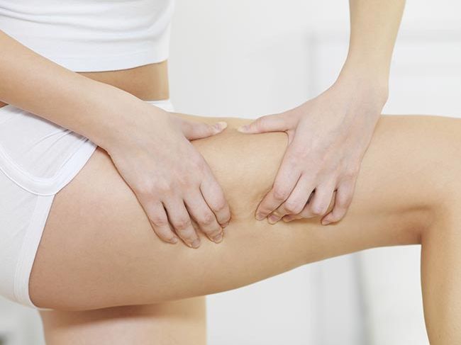 15 Myths and Facts About Cellulite - ABC News