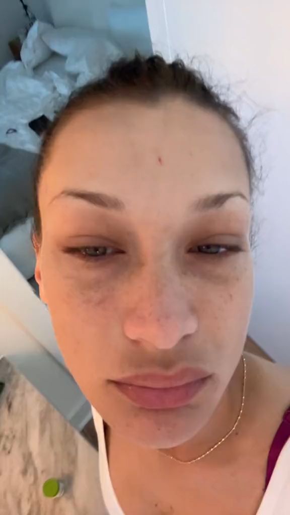 Bella Hadid bravely shared her Lyme flare up with fans on TikTok