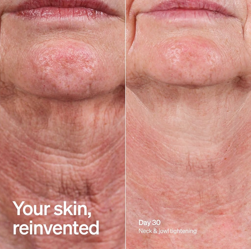 Before and after of woman's neck using Lyma Laser Pro