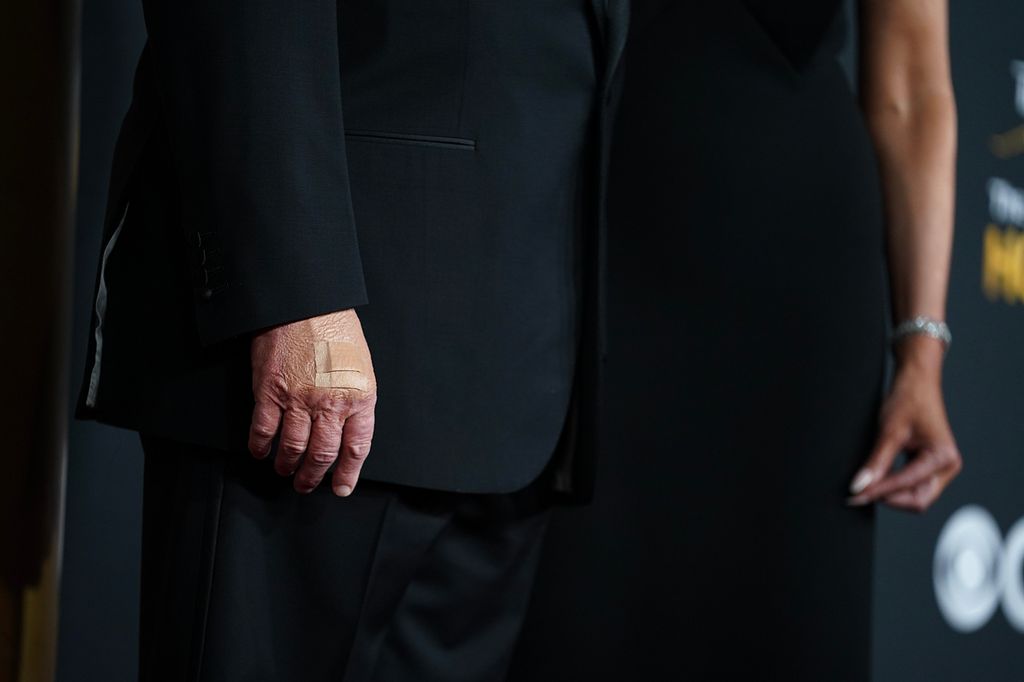 With a bandage on his hand, U.S. President Donald Trump and first lady Melania Trump attend the 48th annual Kennedy Center Honors at the Kennedy Center on December 07, 2025 in Washington, DC