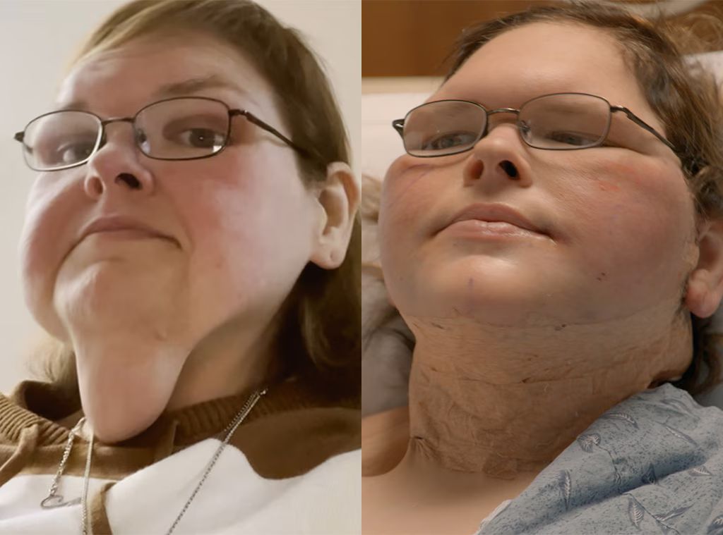 Tammy est avant et après la chirurgie de la peau