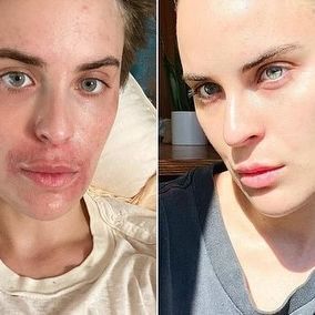 tallulah willis before and after photos skin picking disorder