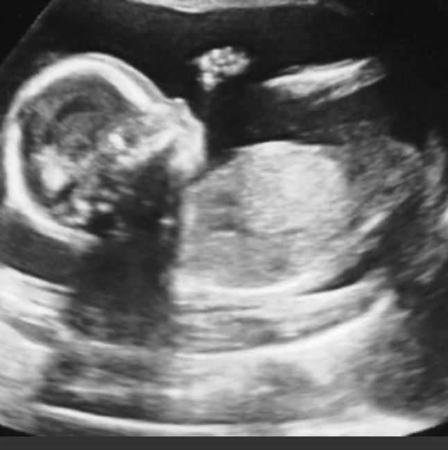 a photograph of a human foetus