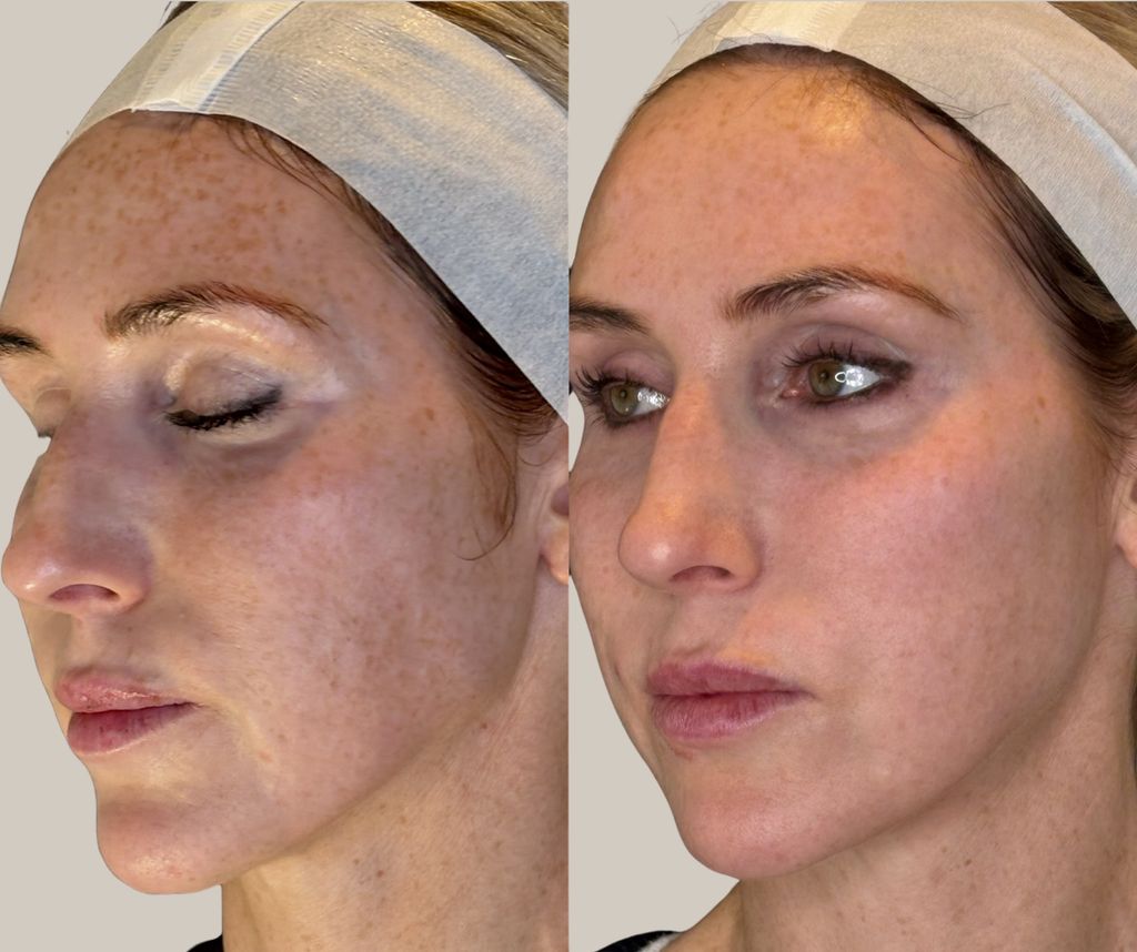 before and after shot of a women's face side on