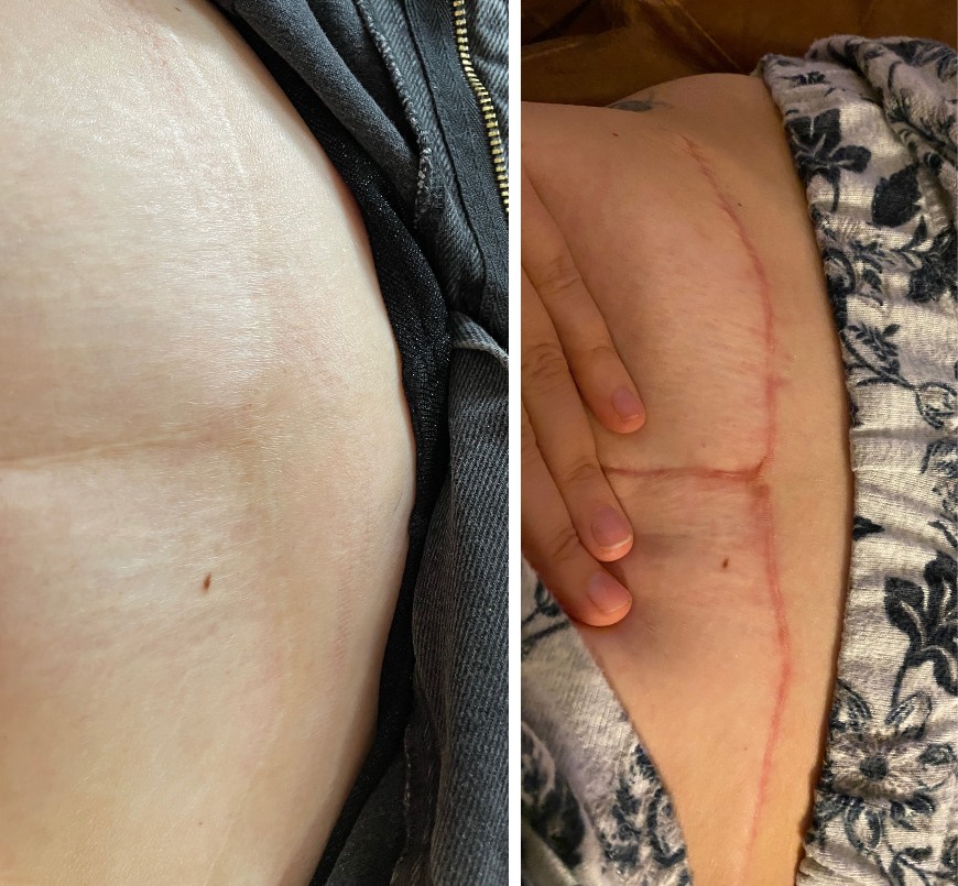 Two images side by side of abdomen before and after surgery