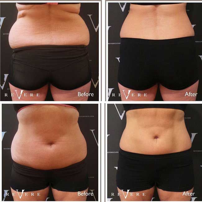 fat freezing before after