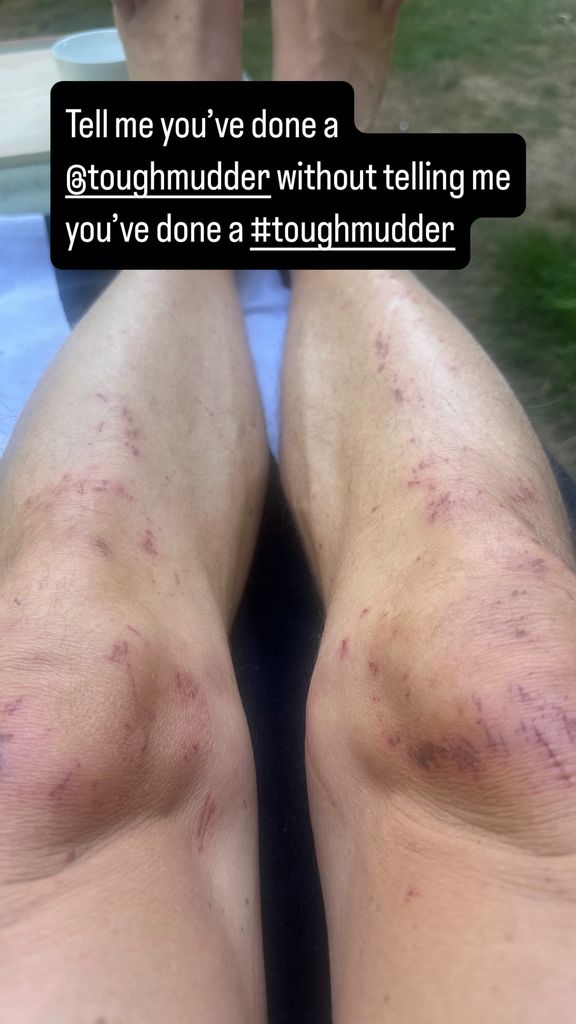 ben shephard picture of cut knees following tough mudder