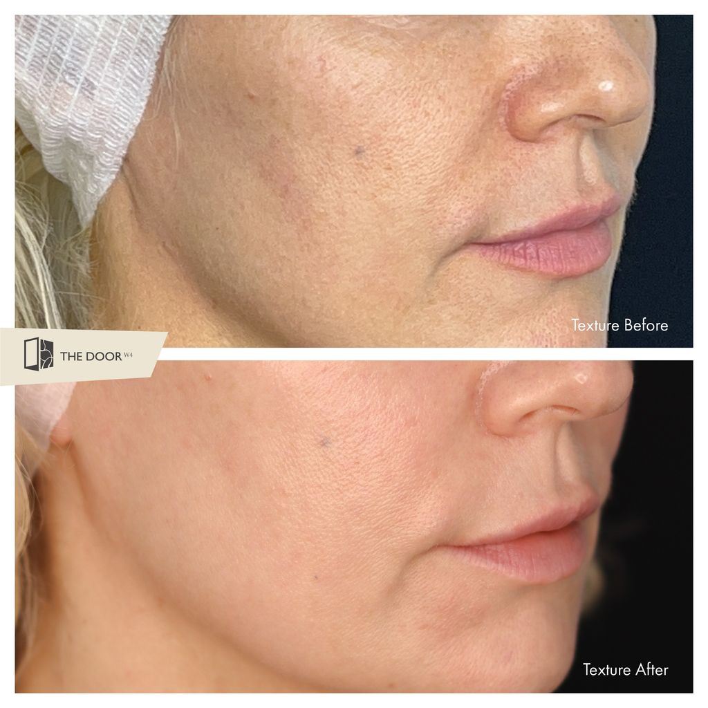 Kristina Rihanoff's skin texture before and after
