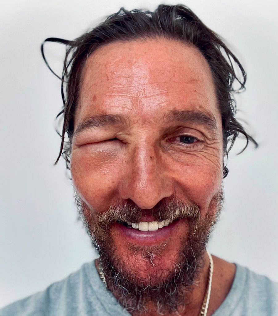 Selfie of Matthew McConaughey shares picture of swollen right eye