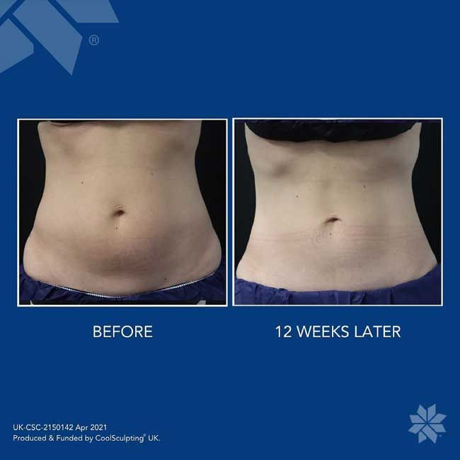 cool sculpting before and after
