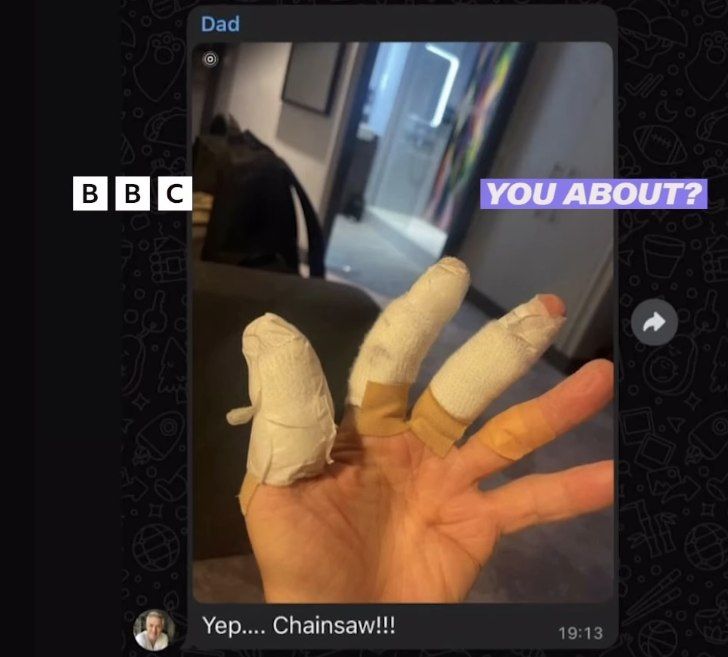 Martin Kemp's bandaged hand