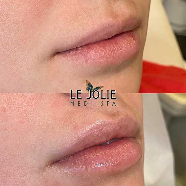 lip flip before after