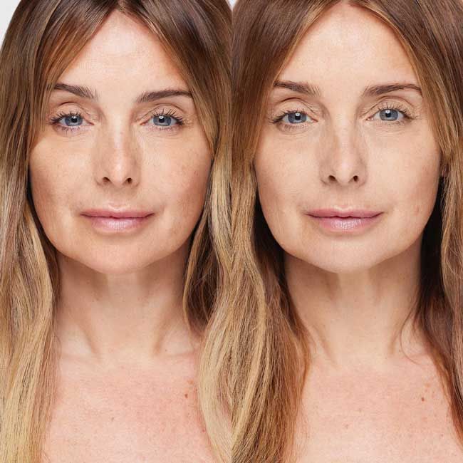 louise redknapp before after