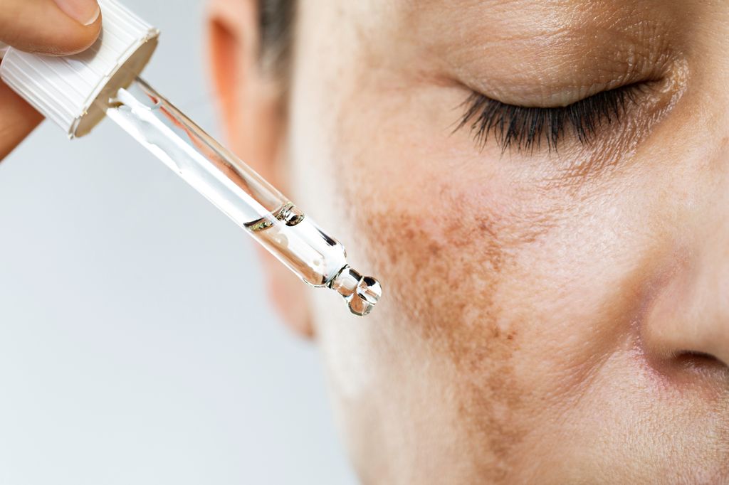 Unrecognizable female suffering from hyperpigmentation (melasma) is about to use face serum for skin brightening.  She has dark spots on her face and  her eyes are closed.
