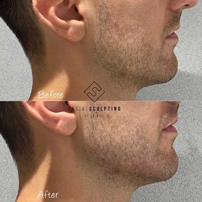 jawline sculpting before after man