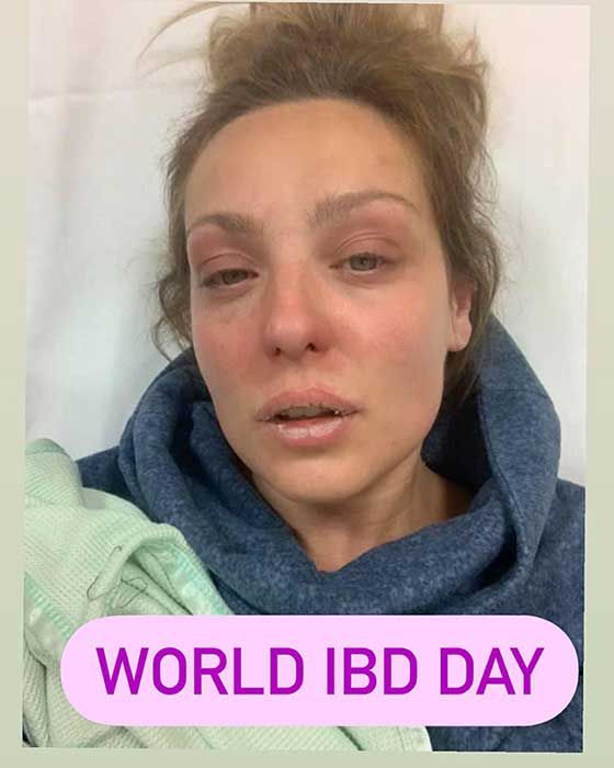 Amy Dowdens candid post on World IBD Day
