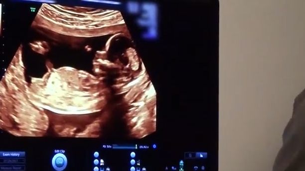 kylie jenner baby scan video