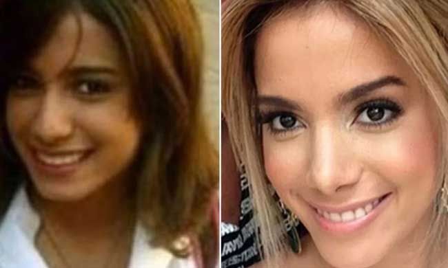 anitta surgery nose before after