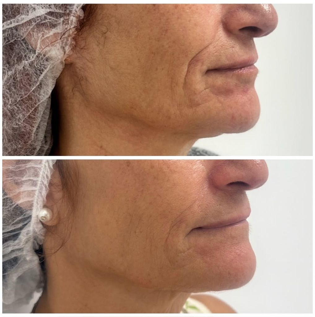 Before and after: three sessions of Morpheus 8, radiofrequency with microneedles