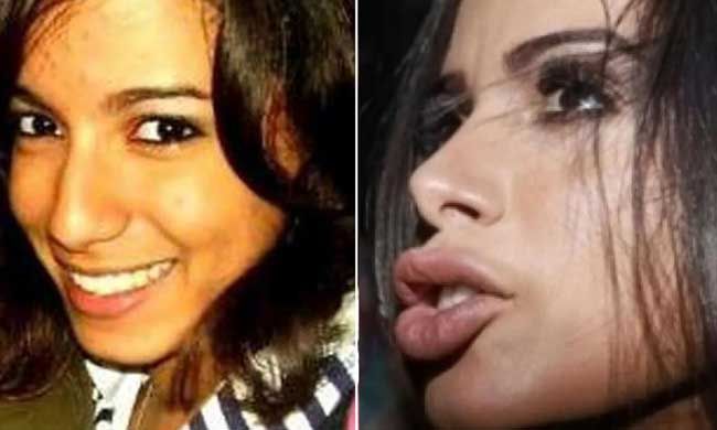 anitta surgery lips before after