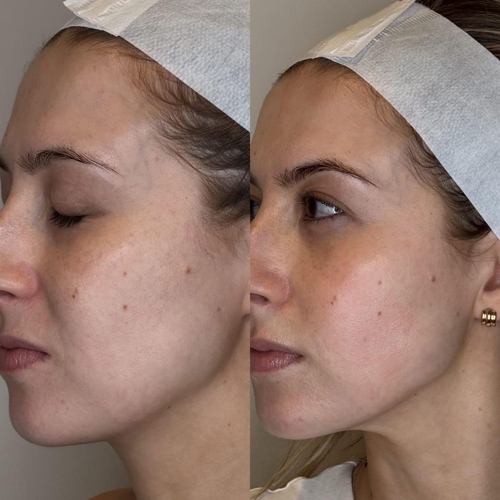 The most noticeable difference in my appearance had to be the improved definition of my jawline 