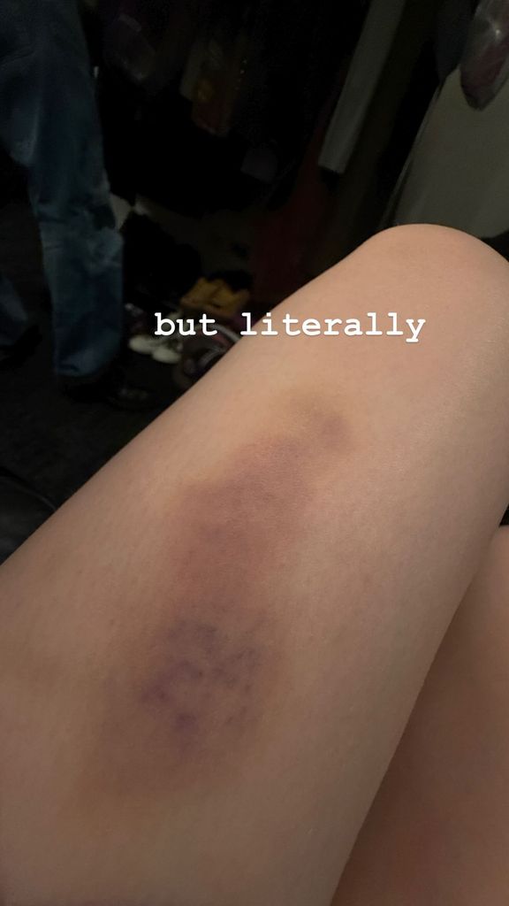 Billie Eilish shows the bruises on her thigh from a fall at Madison Square Garden during her tour, posted on Instagram