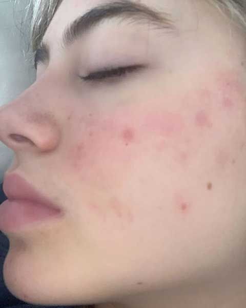 leni klum health battle acne