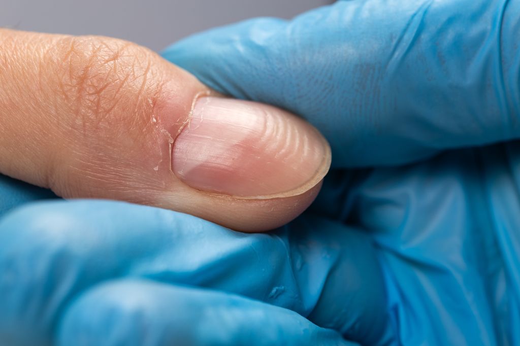 Doctor in gloves examining a ridged fingernail 