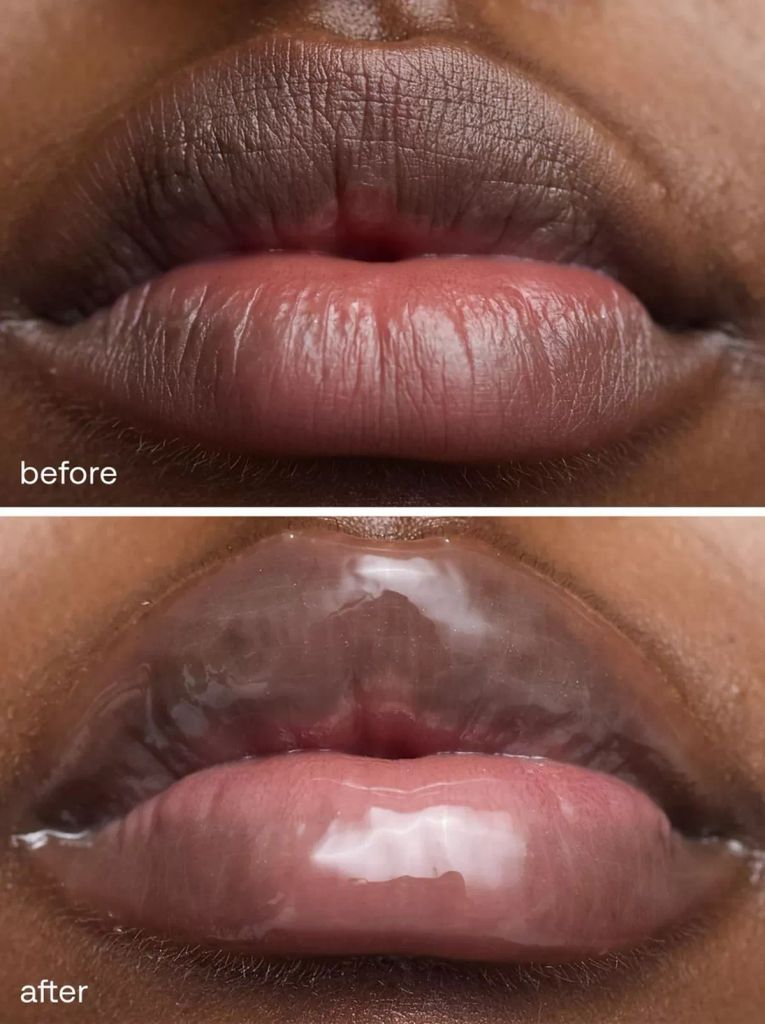 before and after lip plumper