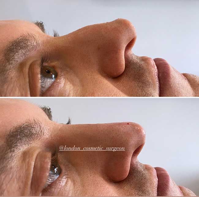 nose correction