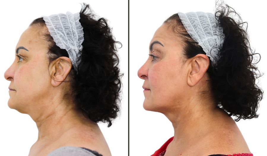 Woman before and after aesthetic procedure