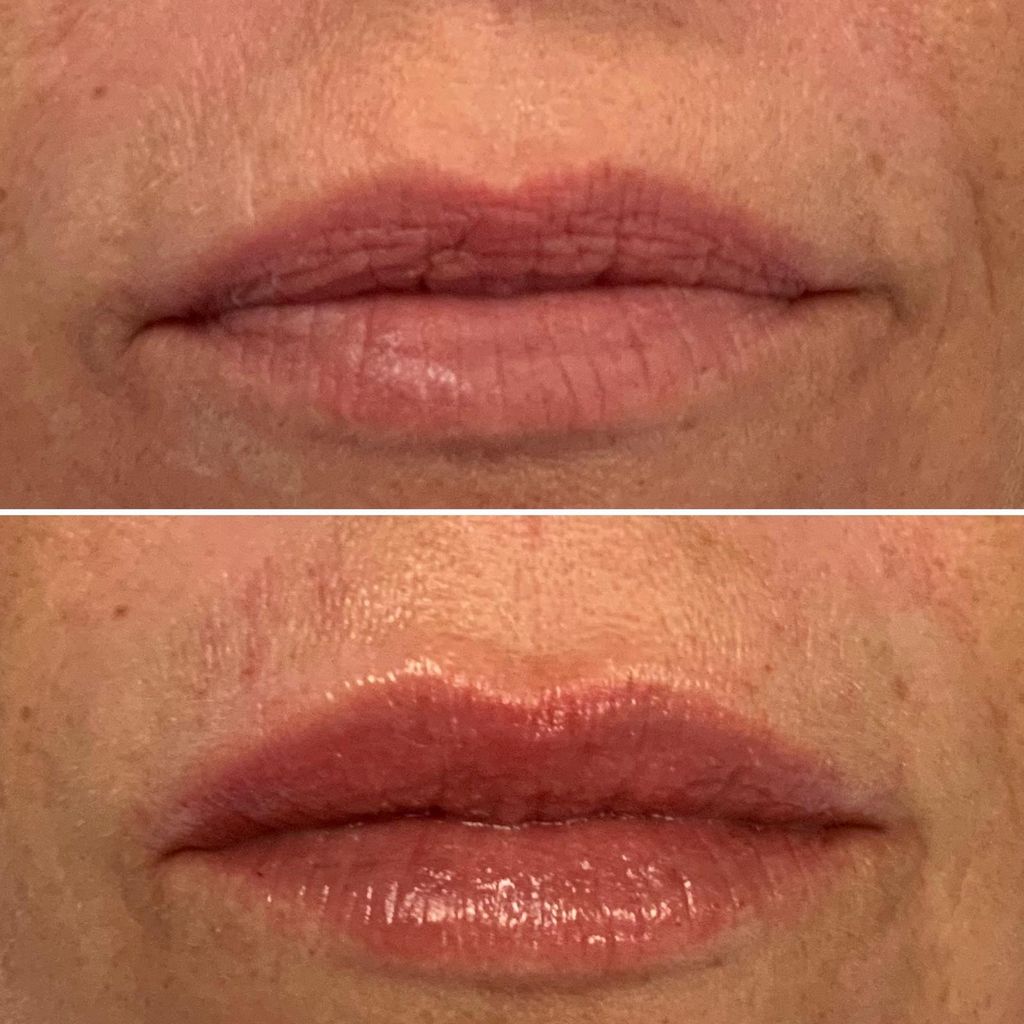 before and after photo of lips before and after lip filler
