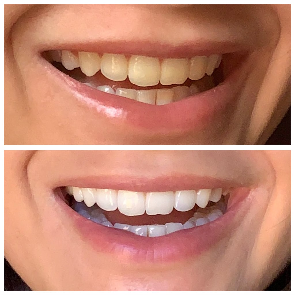 Before and after using MySweetSmile teeth whitening powder