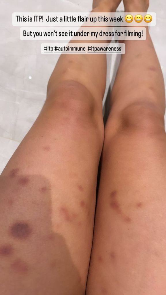 Laura Hamilton's bruised legs