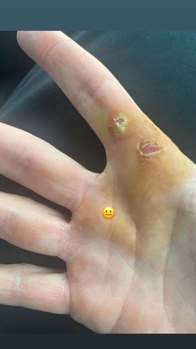 andy murray hand calluses
