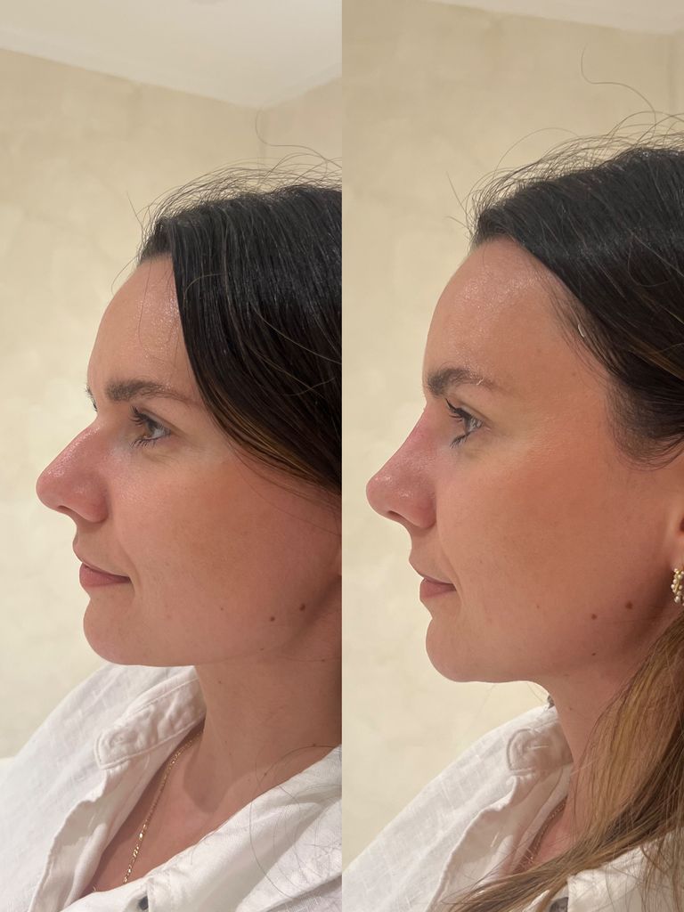 nose job before and after photos