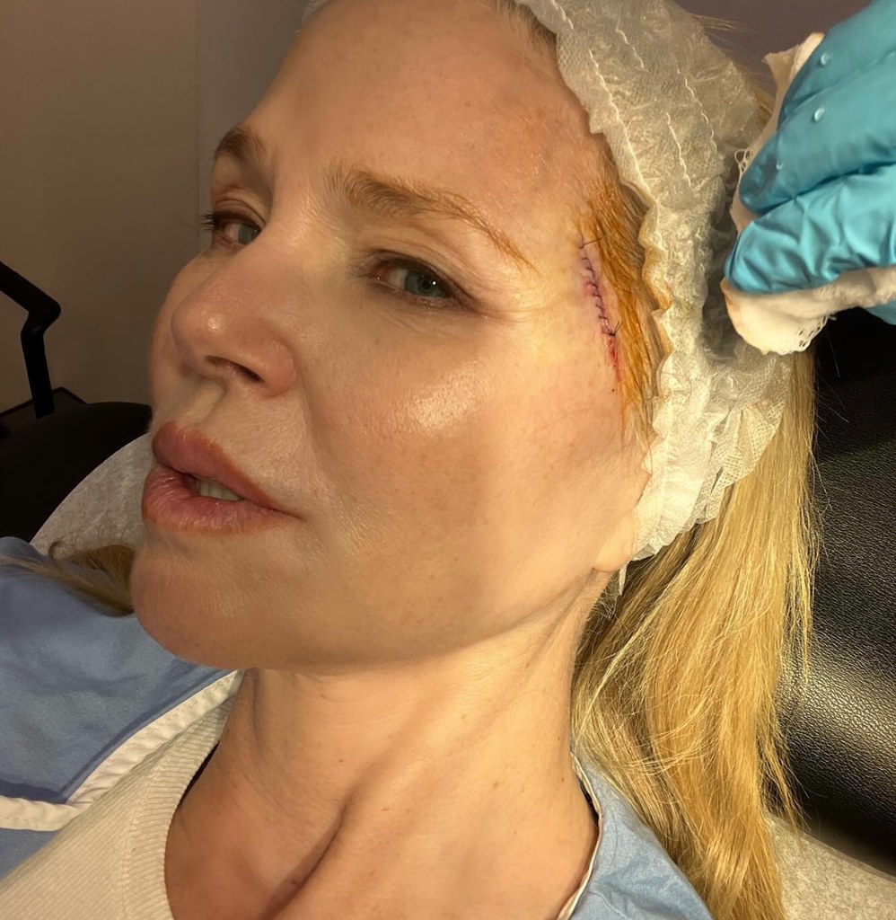 Photo shared by Christie Brinkley on Instagram March 13, 2024, showcasing a scar on her temple as she revealed she had been diagnosed with basal cell carcinoma, the most common form of skin cancer