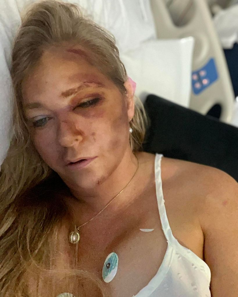 virginia giuffre with bruises on her face in a hospital bed after car crash