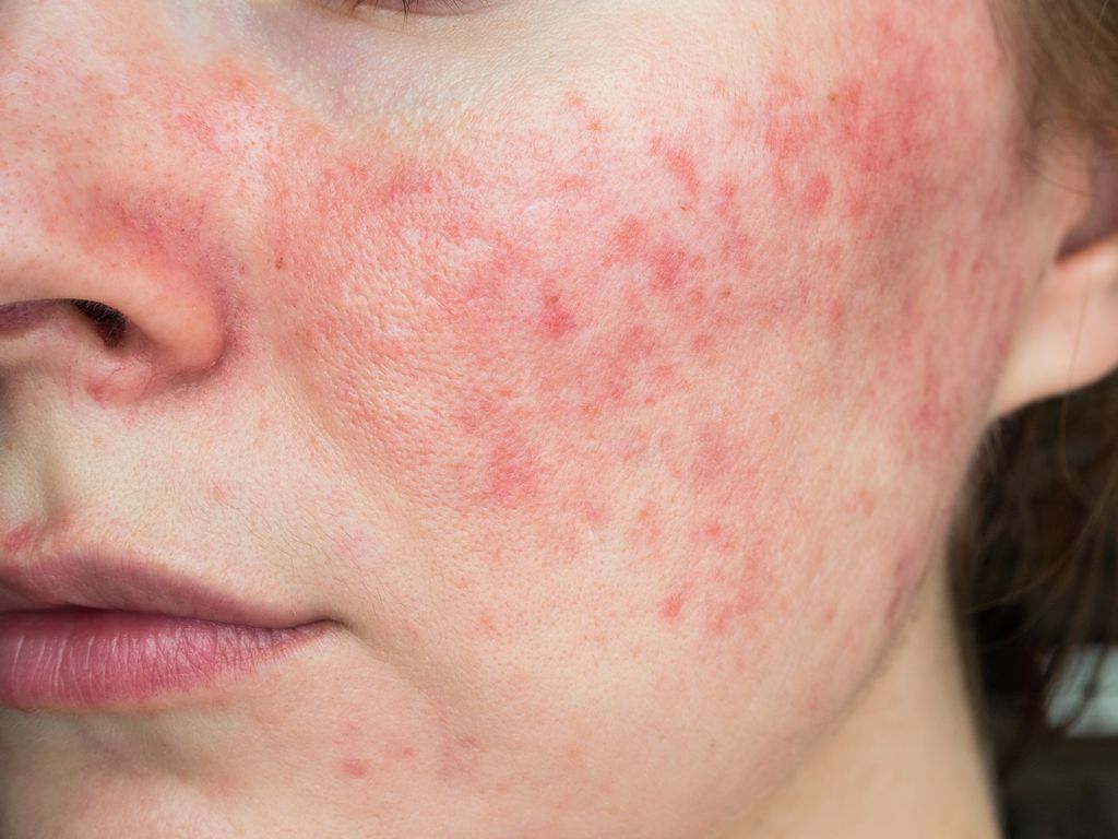  red areas on the skin