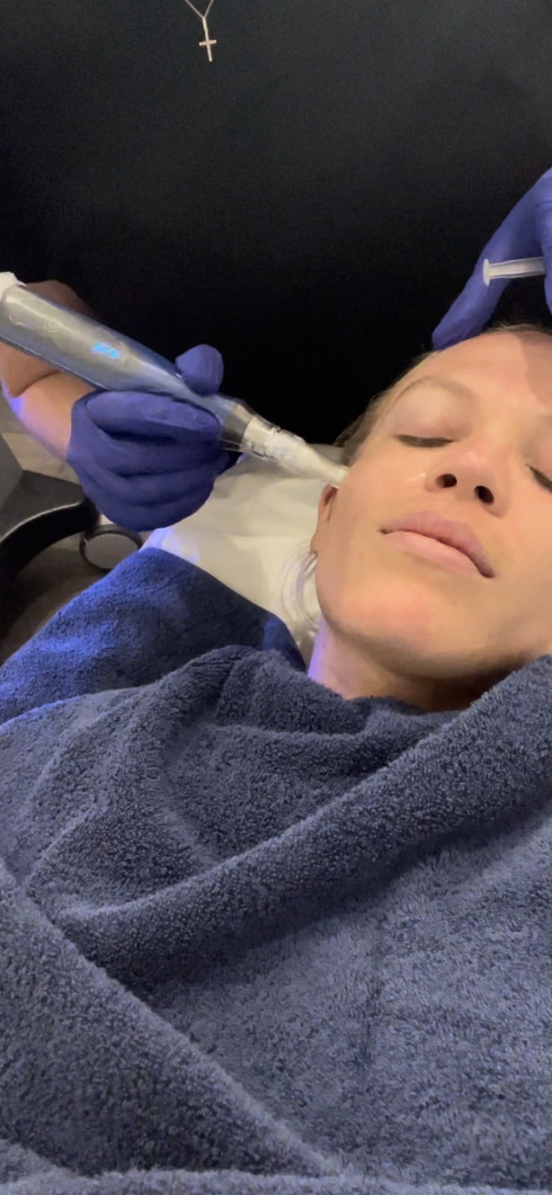 The esthetician held the microneedling pen in her left hand and the 'vitamin cocktail' injection in her left