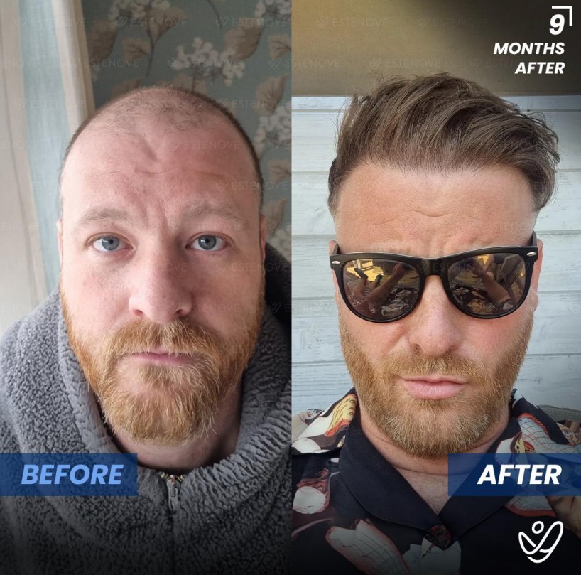 Before and after photos of a hair transplant