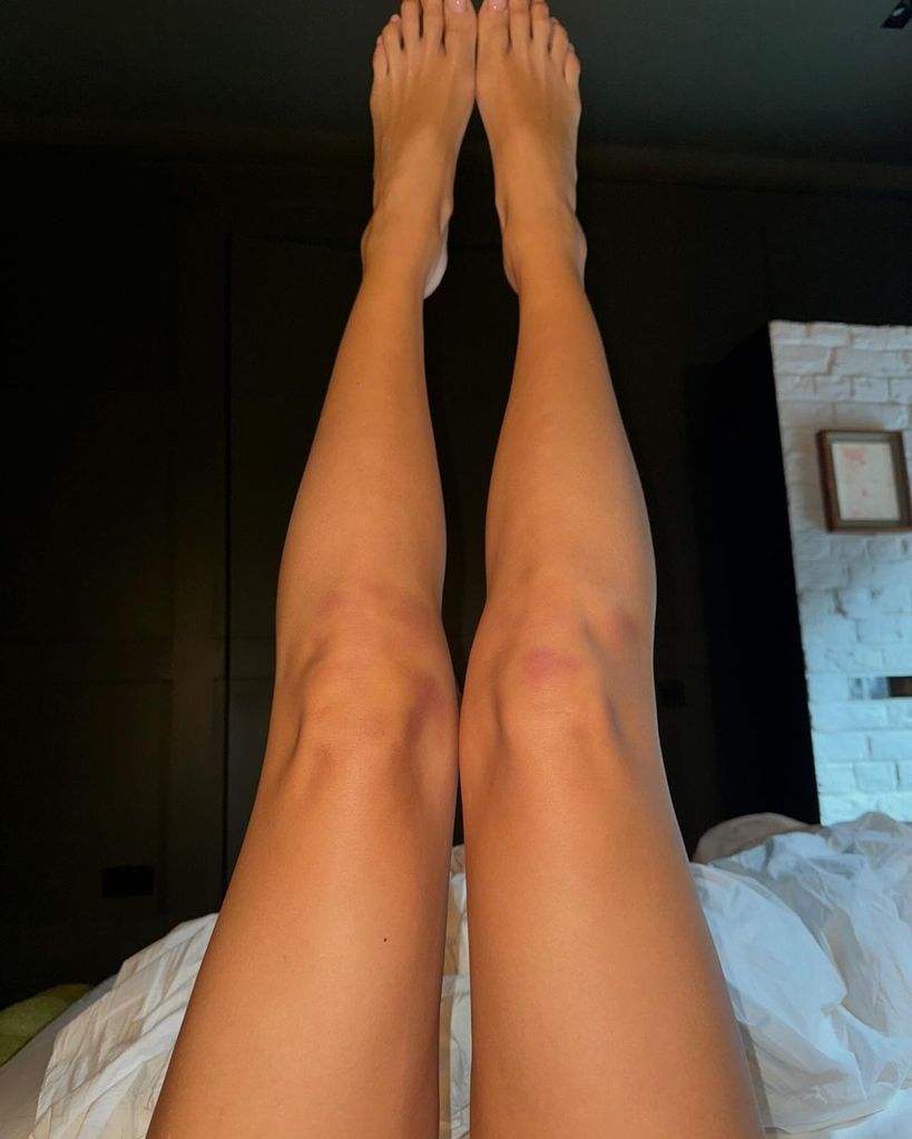 Dua Lipa shows the bruises on her legs while filming the video for "Houdini," shared on Instagram