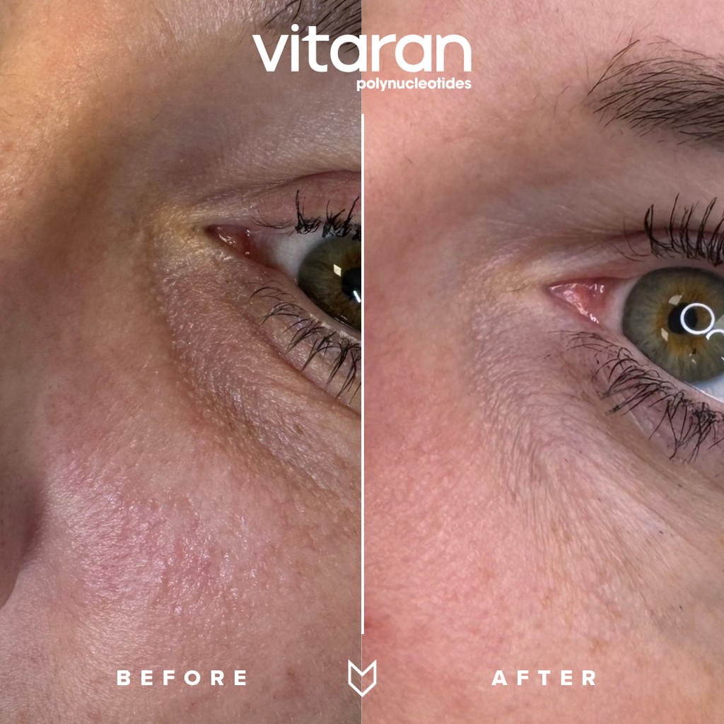 Side by side photo of before and after eye treatment