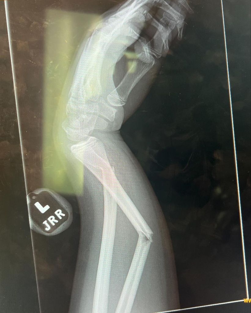 Kourtney Kardashian shared a photo of a broken arm and fans wondered whose it was