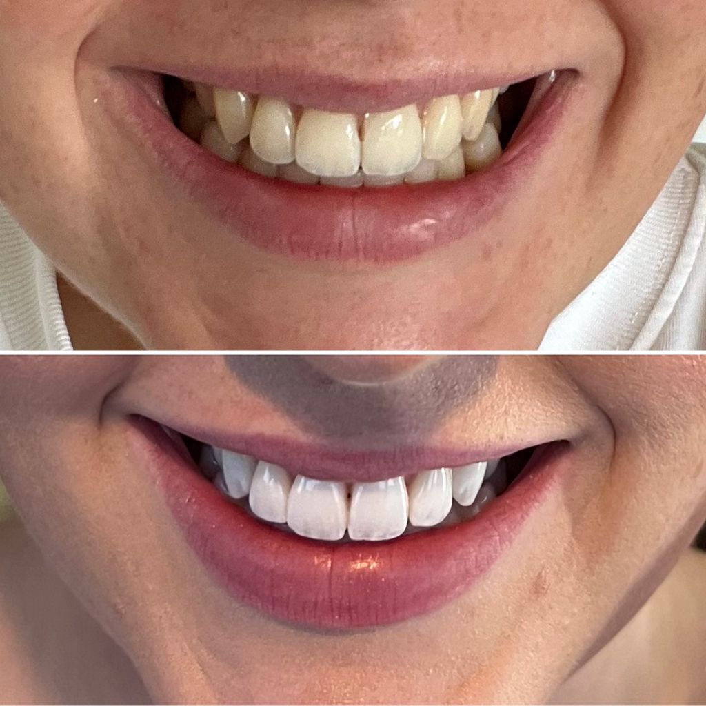 teeth before and after mini smile makeover
